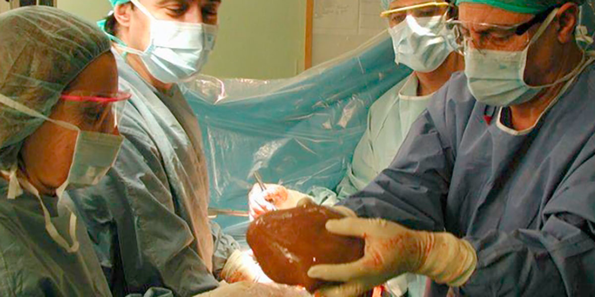 Imagen de uno de los trasplantes hepáticos llevados a cabo en el Clínico