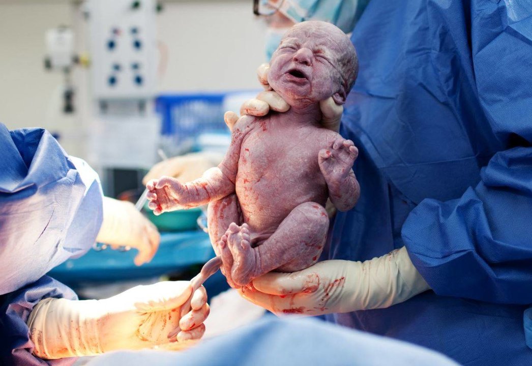 En la imagen, un parto por cesárea nacido bebé/ Foto: Adobe Stock