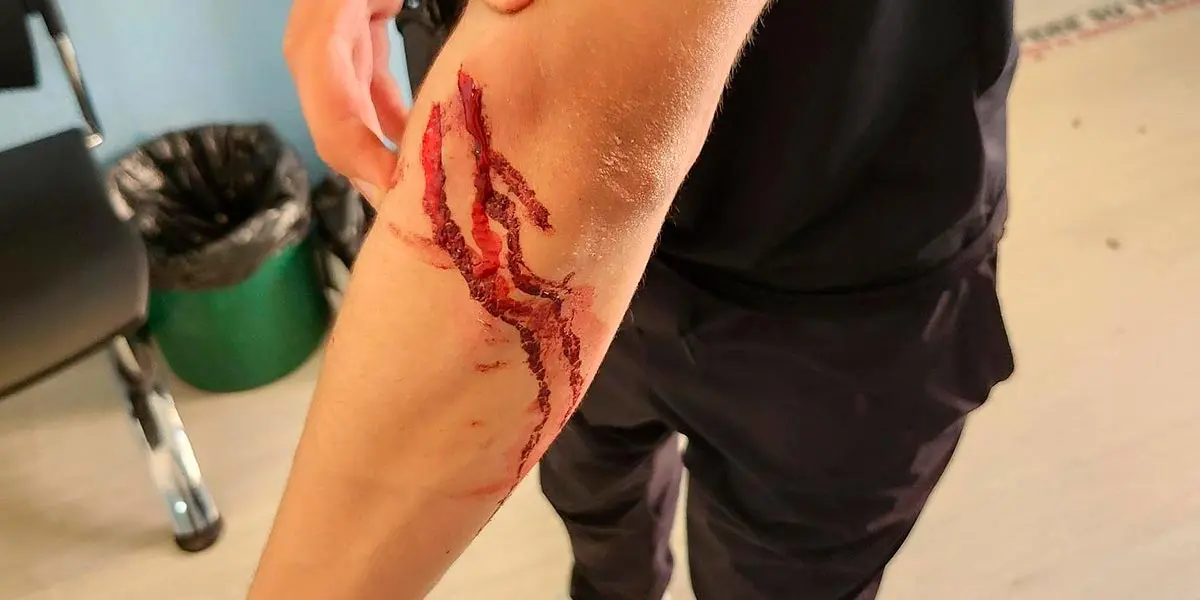 Herida en el antebrazo del joven tras el presunto apu&ntilde;alamiento ocurrido en el paseo del Queiles