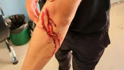 Herida en el antebrazo del joven tras el presunto apu&ntilde;alamiento ocurrido en el paseo del Queiles